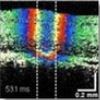 Thermal expansion and retinal tissue changes during photocoagulation