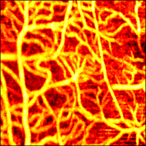 OCT Angiography